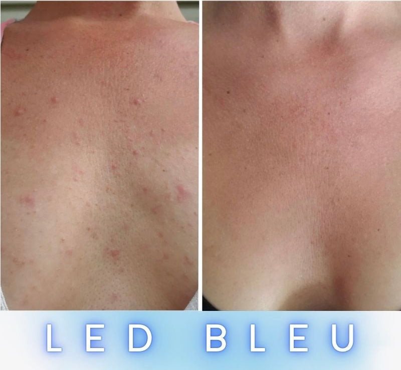 Masque LED Anti-Âge Pro - Cou et Décolleté