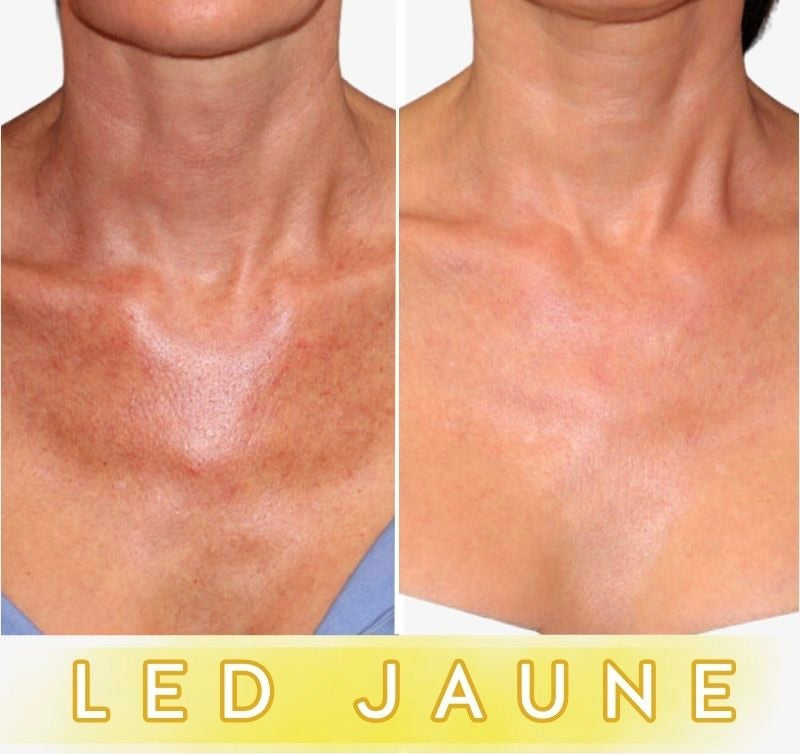 Masque LED Anti-Âge Pro - Cou et Décolleté