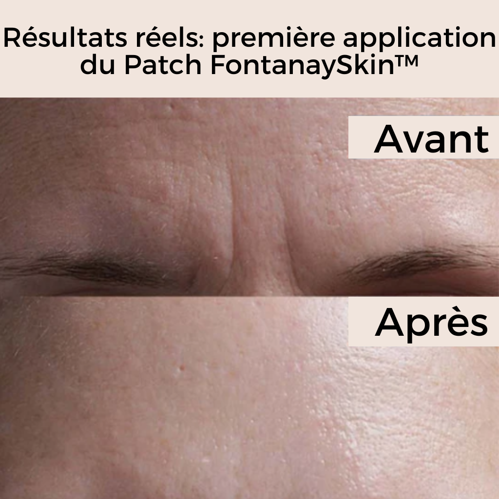 Patchs Visage Anti-Rides Réutilisables FontanaySkin™